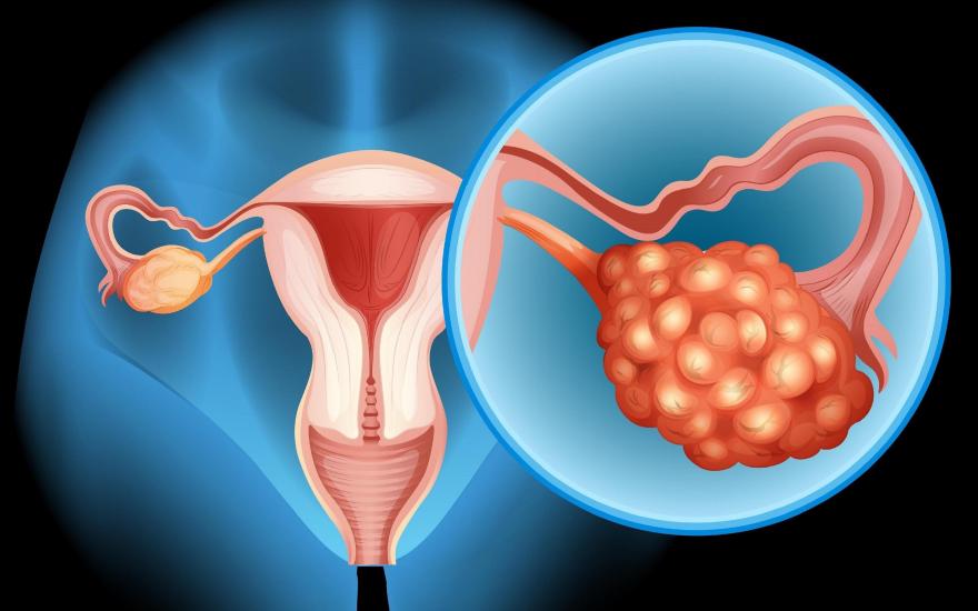 ovarian
